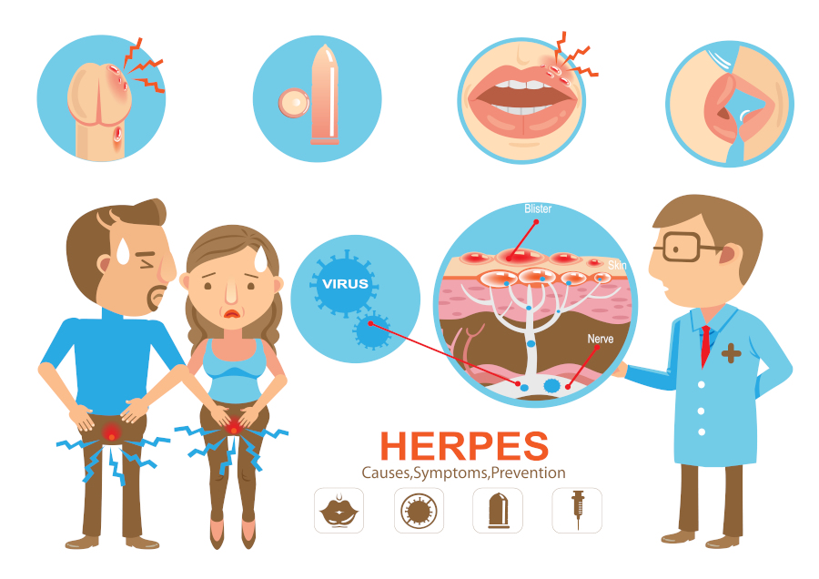 20 Q&A about Herpes